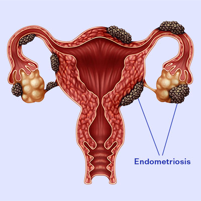 Channel 5 News - MPs say women with endometriosis are not getting diagnosed  quickly enough and their treatment is unacceptable. The condition affects  around one in 10 women and can cause serious